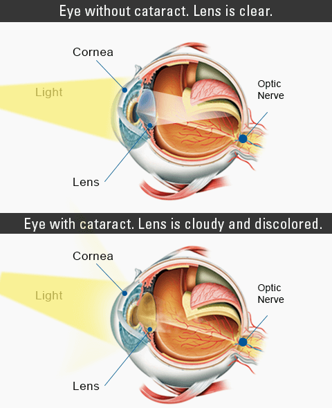 What Is Cataract | David Richardson, MD - Glaucoma, Cataract Surgeon