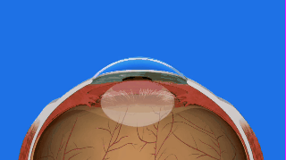 Intraocular Lens Insertion via EyeSmart — American Academy of Ophthalmology on YouTube